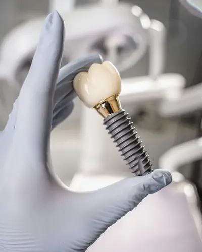 Coroană dentară din ceramică montată pe un implant